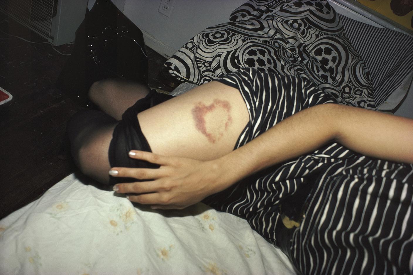 B_Heart-shaped bruise, New York City 1980.jpg