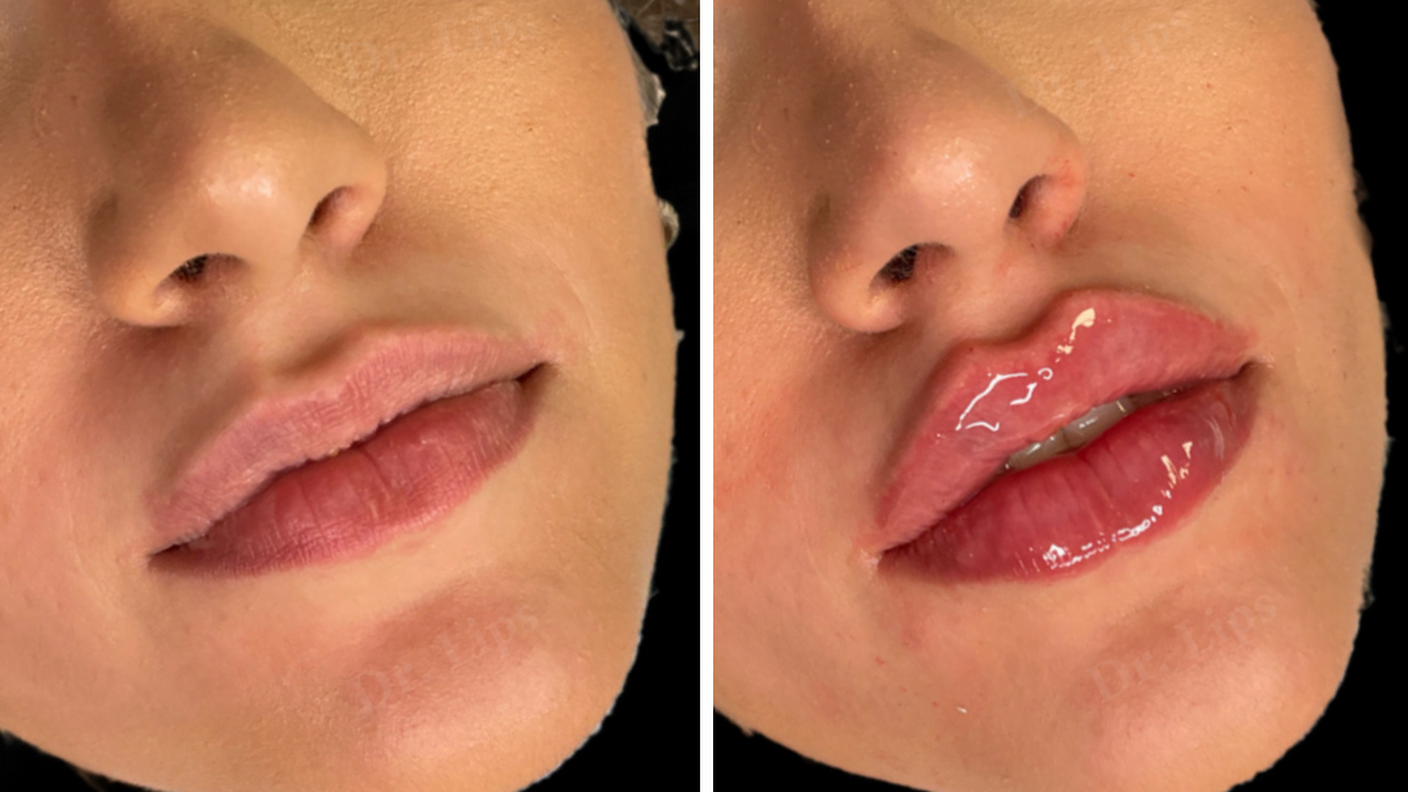 drlips-filler-labbra.png