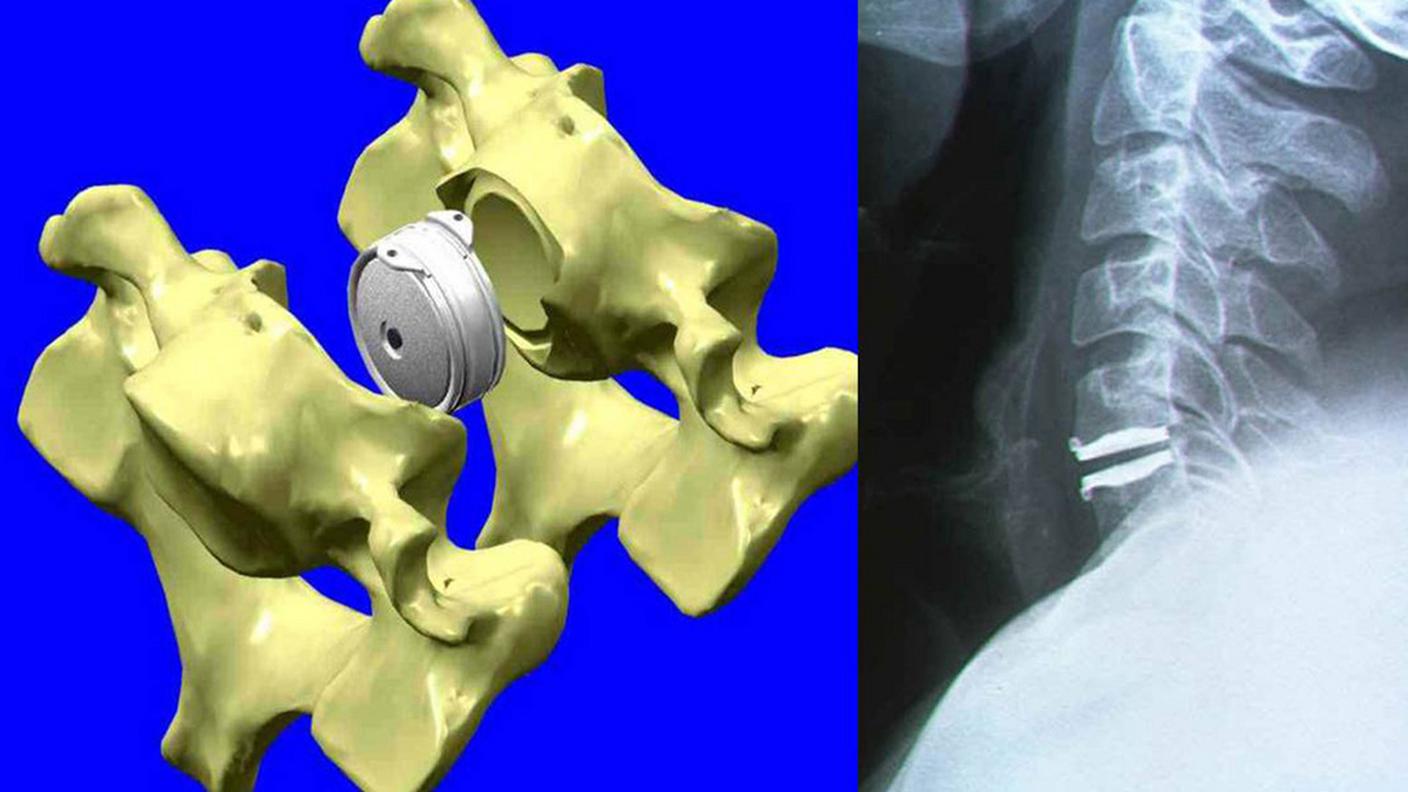 Un esempio di protesi formata da un disco di titanio avvolto in materiale sintetico