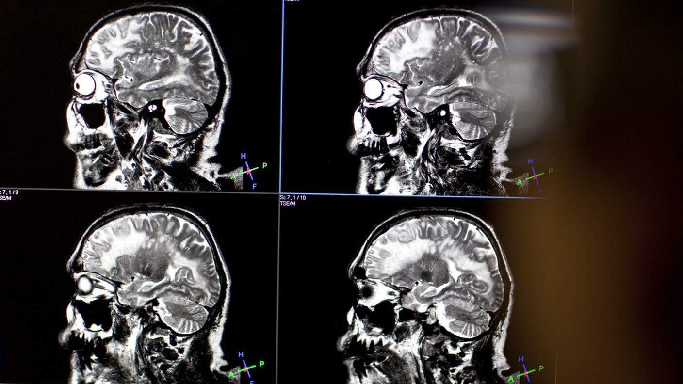 Analisi del cervello effettuate all'Università di Zurigo