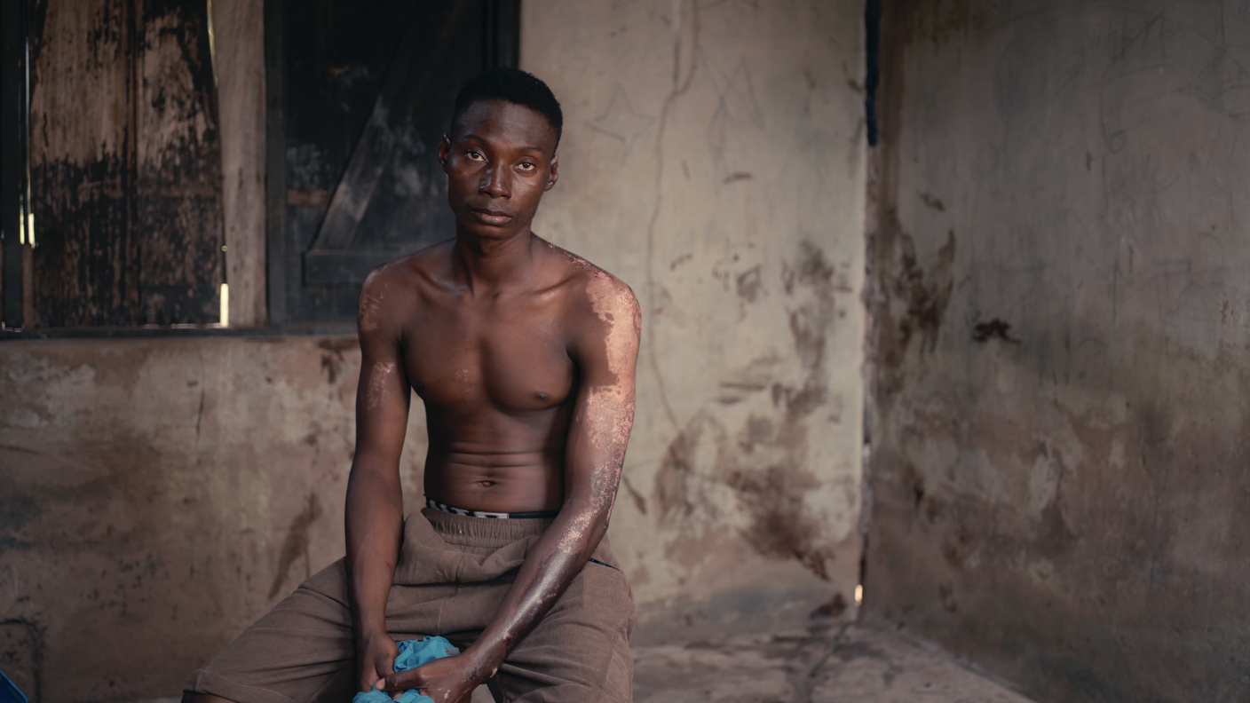 Teryila. Villaggio yelwata, Benue è uomo sopravissuto ad attacco fulani. Ha perso tutta la famiglia arsa viva in casa.