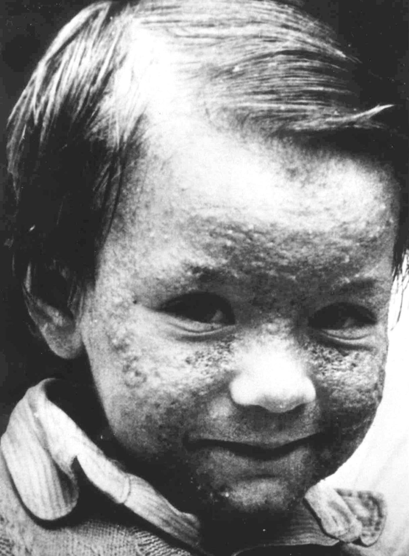 Molti bambini soffrirono di conseguenze alla pelle
