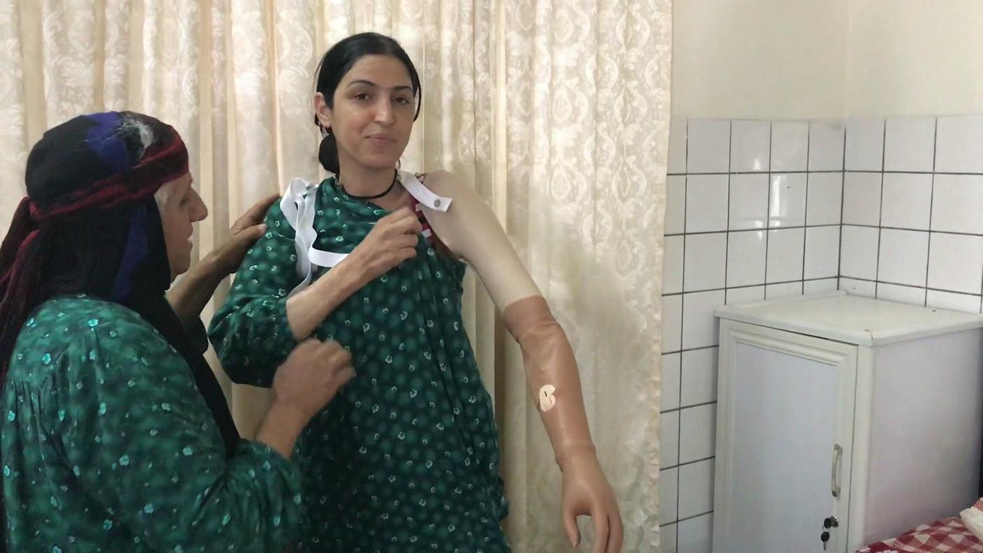 Farah, 27 anni, senza un braccio, prima di ricevere la protesi si vergognava cercava sempre di nascondersi