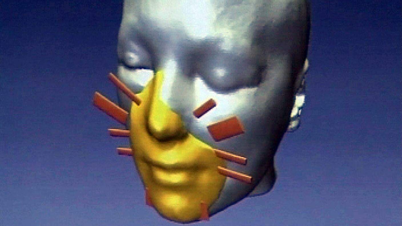 Ricostruzione virtuale della faccia di un paziente prima dell'intervento