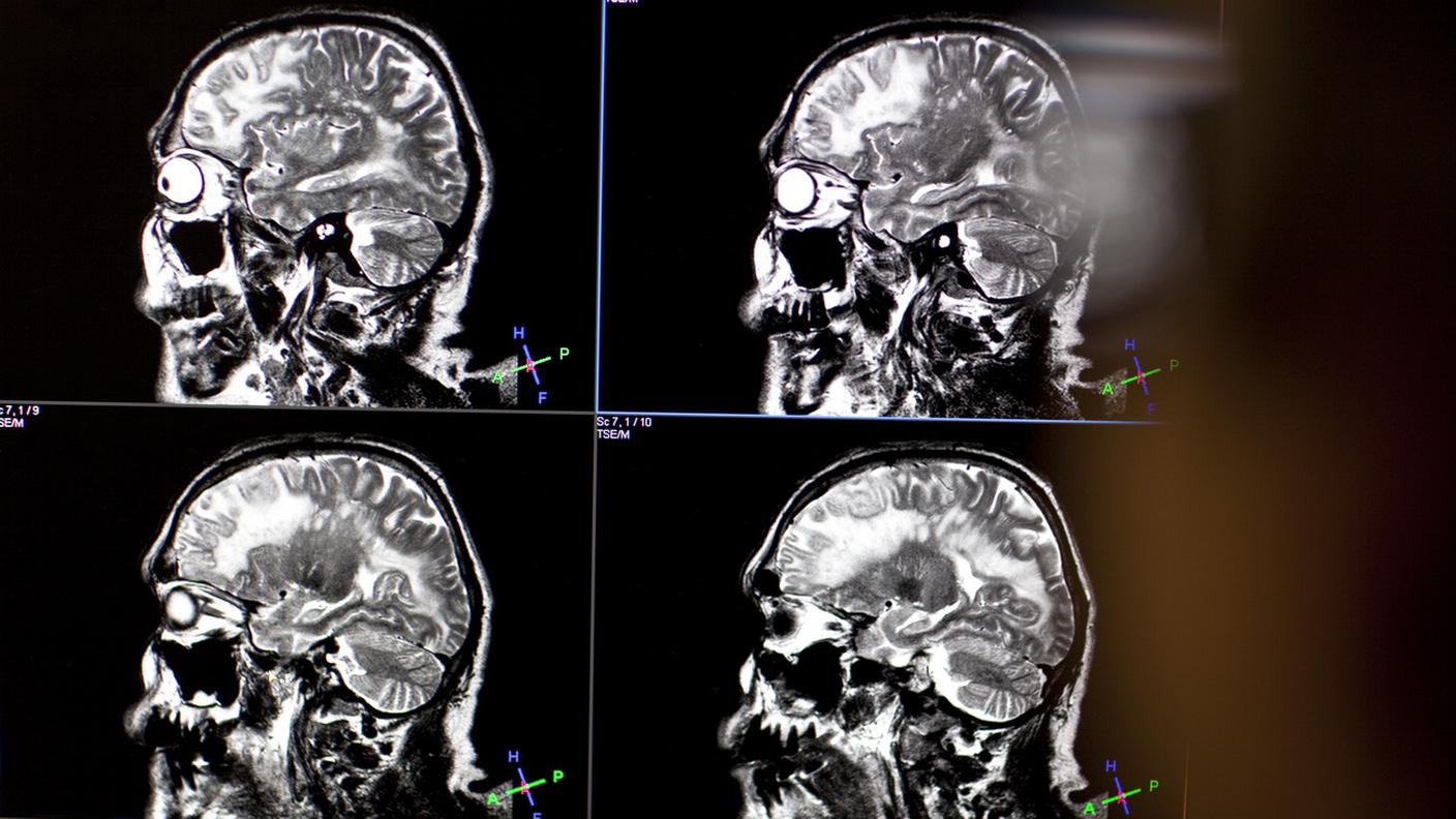 Una mutazione genetica responsabile delle malattie mentali