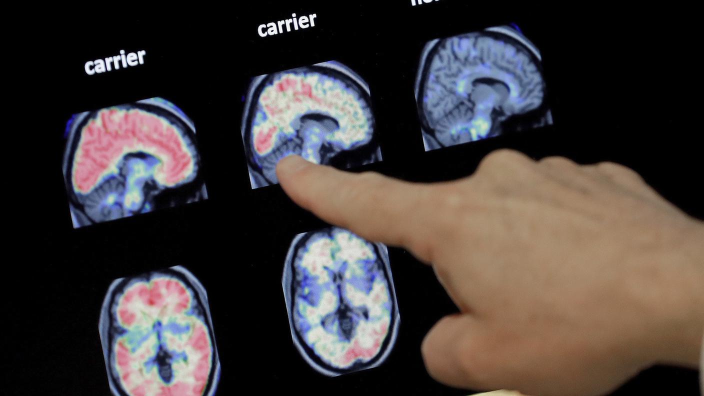 Una malattia sempre più diffusa con l'invecchiamento