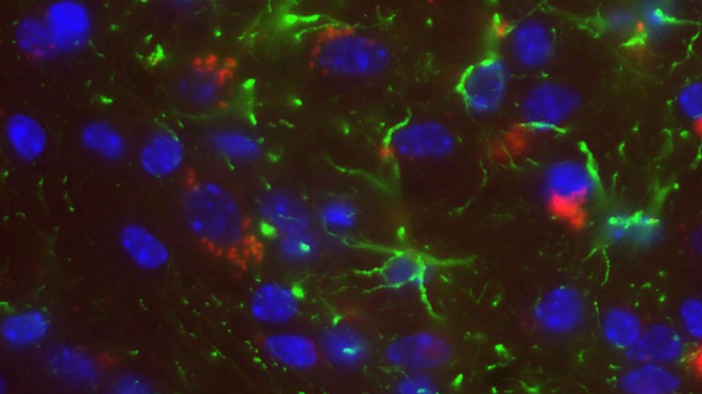 La perdita del cromosoma Y potrebbe portare all'Alzheimer