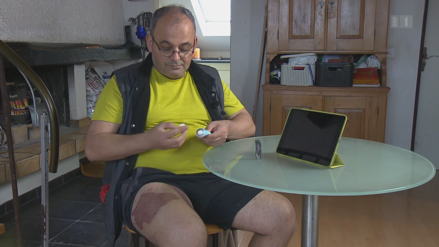 L'ustione riportata dallo sfortunato "svapatore"