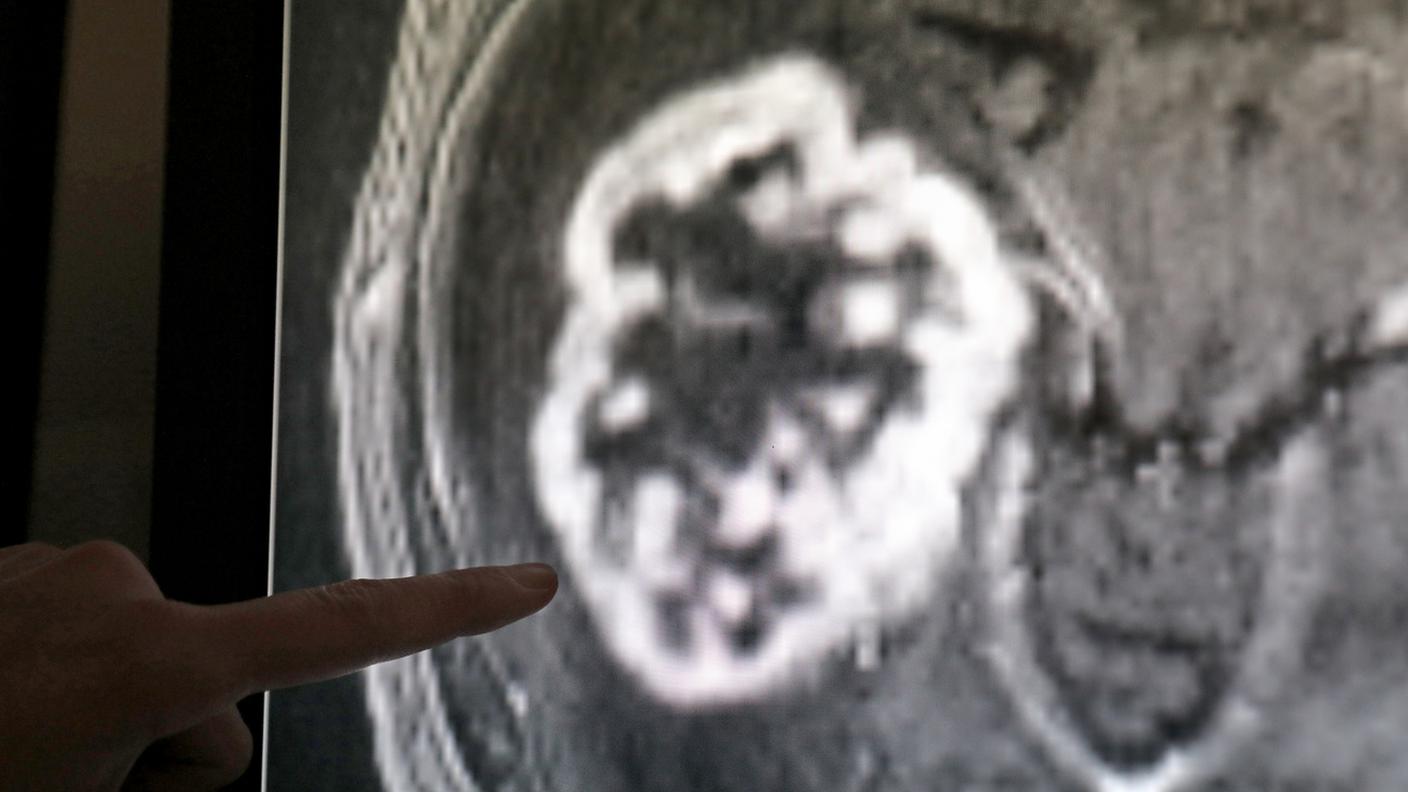Sanno "riconoscere" le cellule tumorali grazie a una molecola specifica