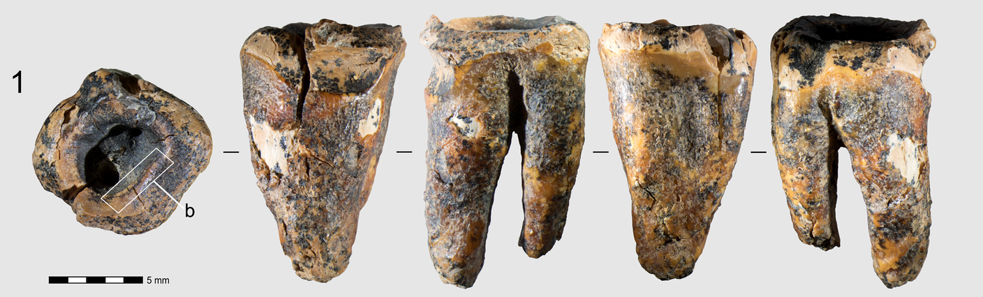 Il dente visto da cinque prospettive differenti; a sinistra la cavità che ha attirato l'attenzione dei ricercatori 