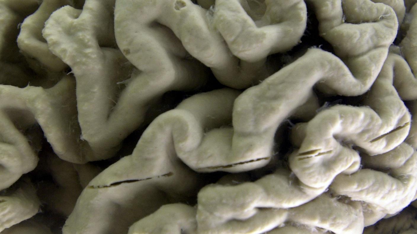 La medicina anti-Alzheimer ha avuto effetti positivi su decine di pazienti ma rimane molto da fare