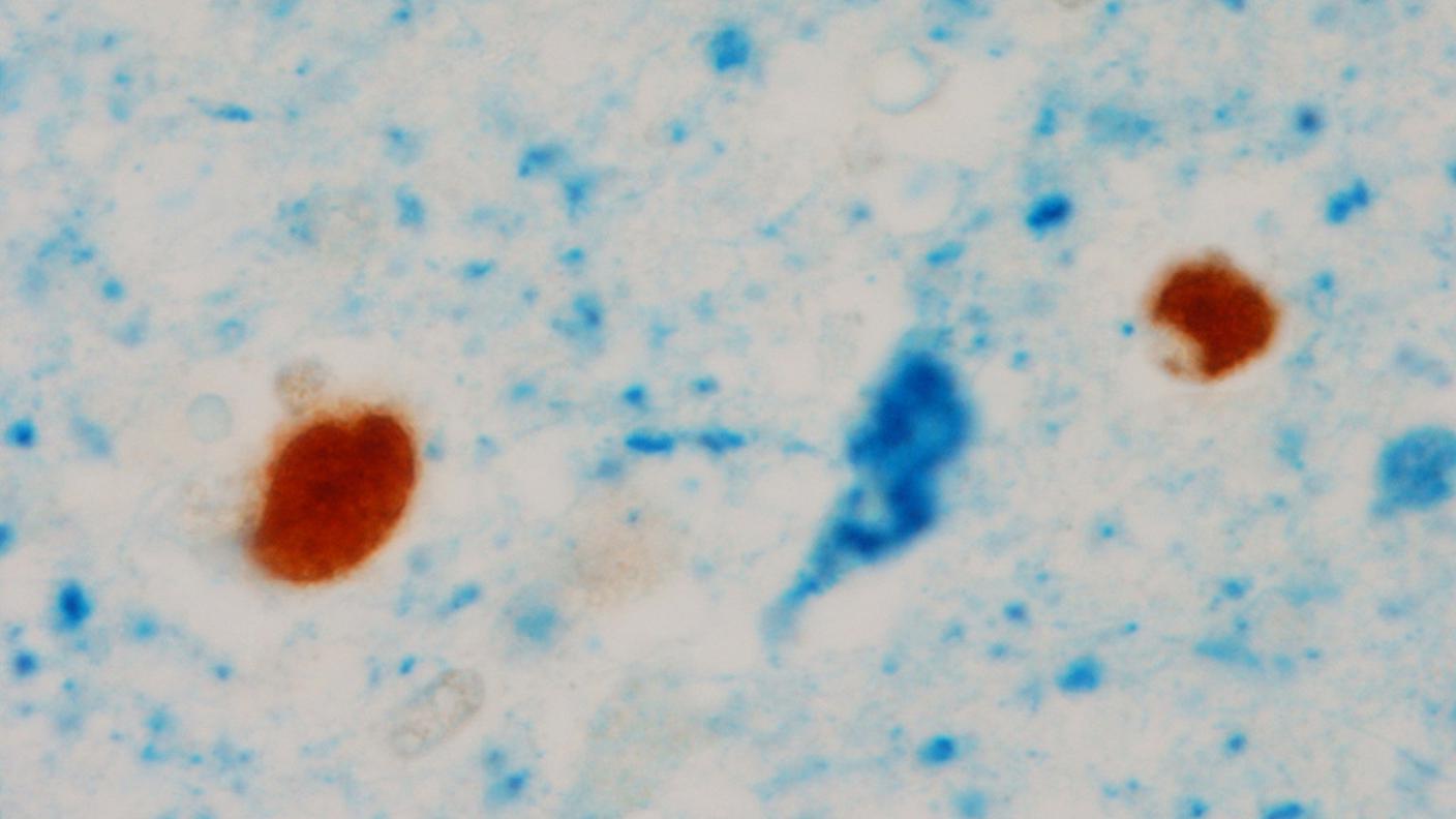 Nuova scoperta per combattere l''Alzheimer