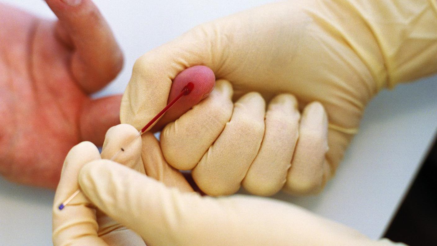 Analisi del sangue per trovare l'Alzheimer
