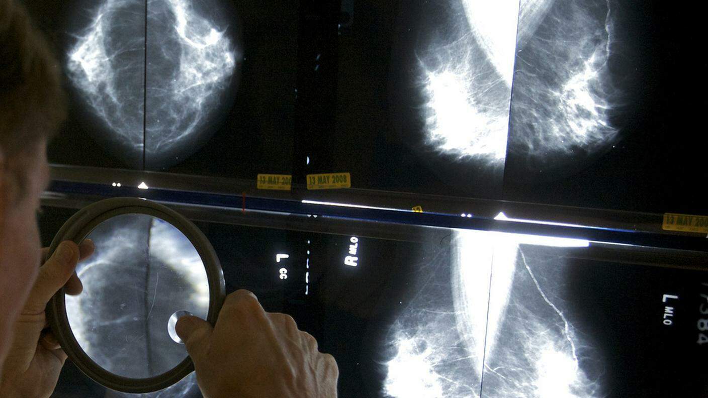 Ogni anno, in Svizzera, vengono diagnosticati 5’500 casi di cancro al seno 
