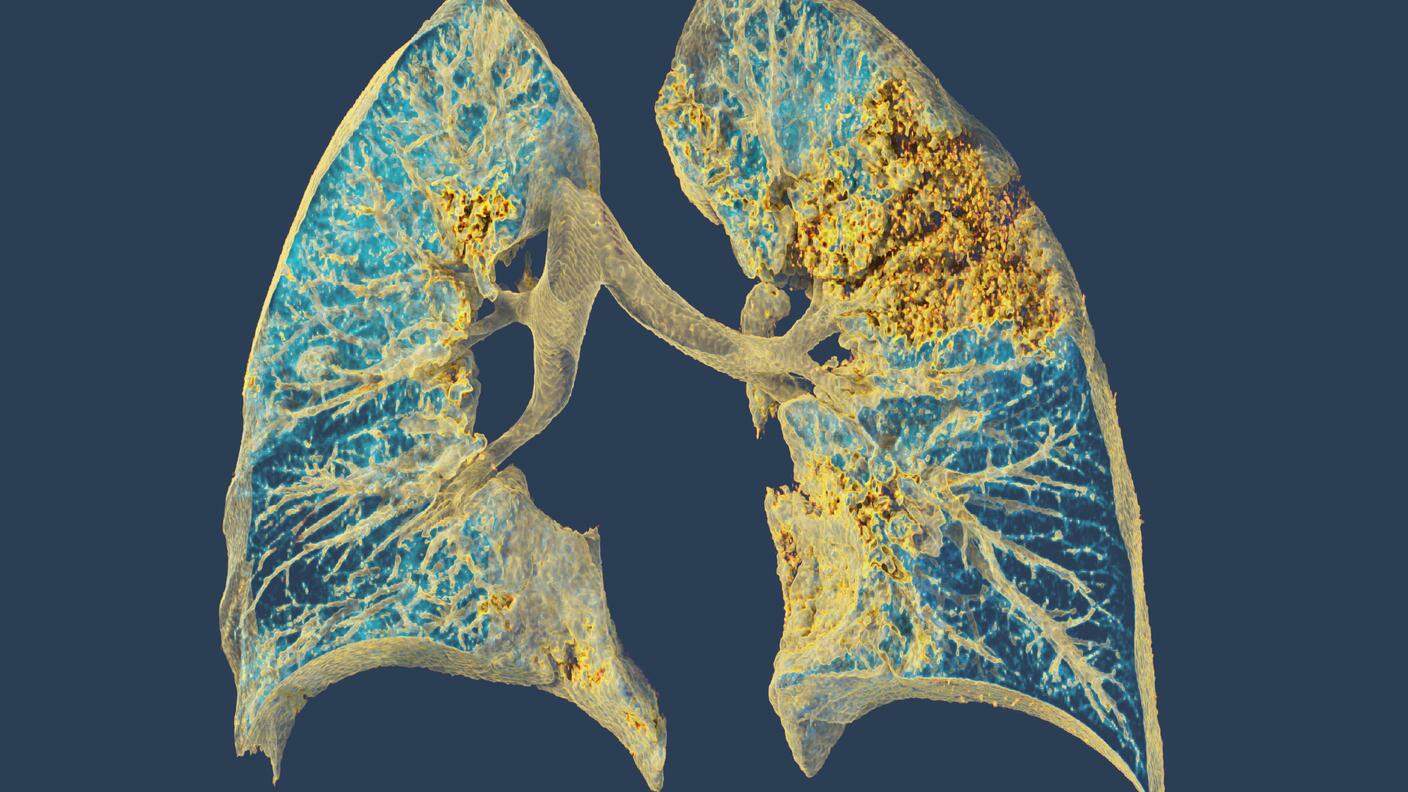 I polmoni di un 30enne malato di Covid-19