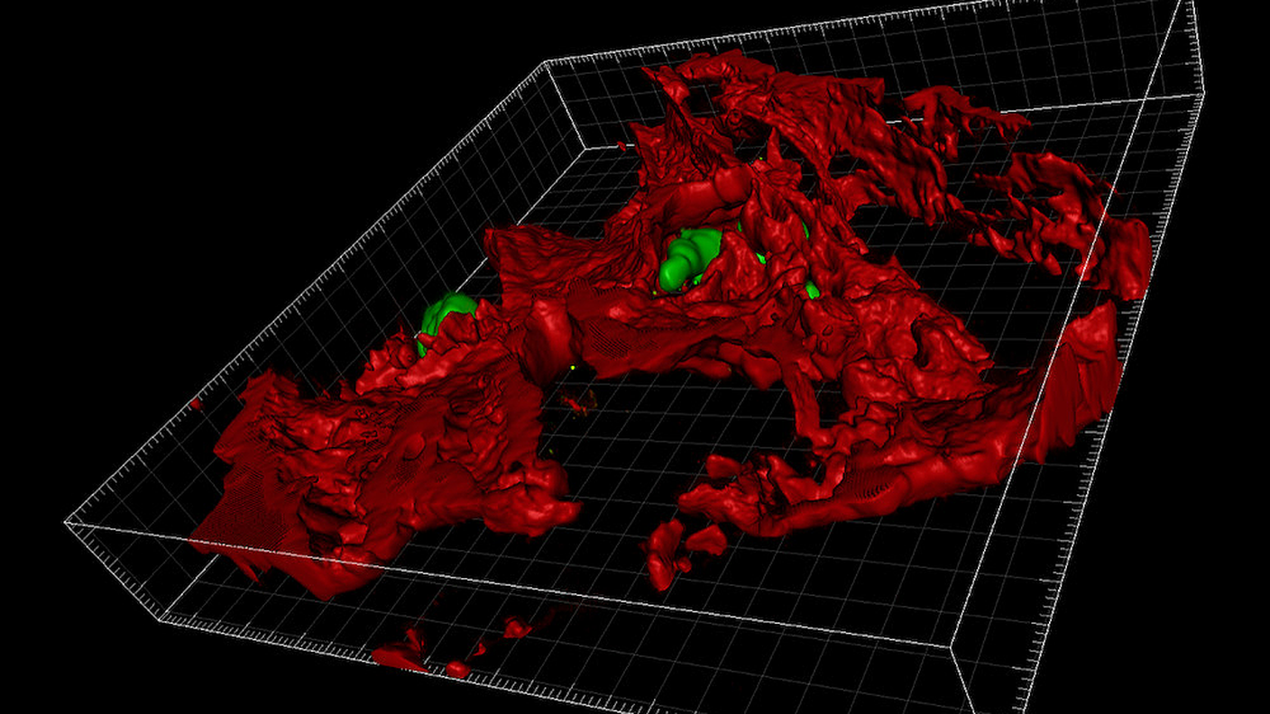 L'invasione di cellule del cancro al seno (in verde) con proteina ZEB1 su un tessuto osseo (in rosso)