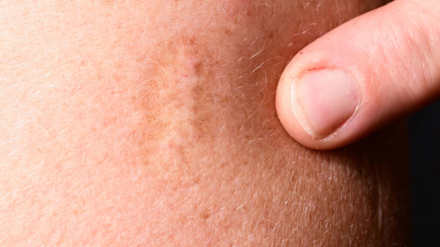 Chi ha ricevuto la vaccinazione contro il vaiolo è protetto efficacemente