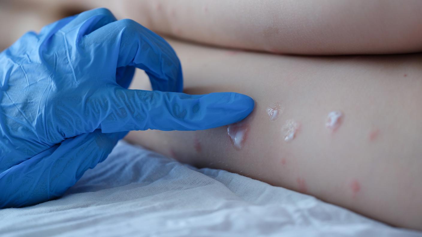 In arrivo di vaccini contro il vaiolo delle scimmie