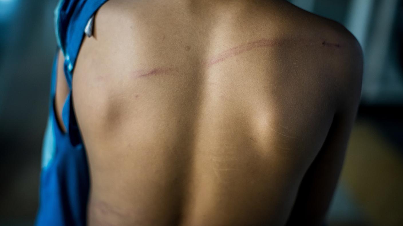 Ferite bambino schiena violenza abuso