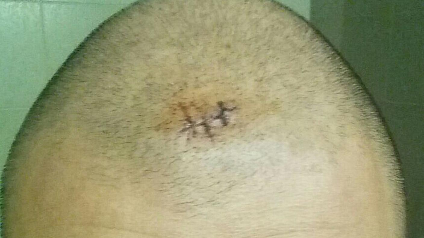 I segni della sprangata ricevuta in testa dall'agente luganese