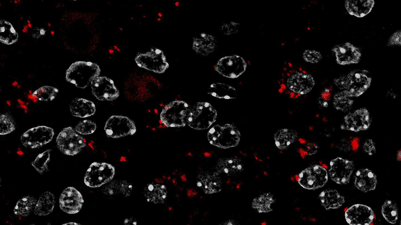Le cellule tumorali in un tumore prostatico accumulano goccioline di lipidi (in rosso). In grigio i nuclei