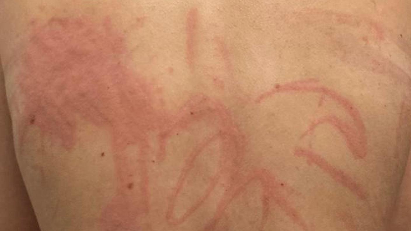 Testimonianze di casi di orticaria inviate alla redazione