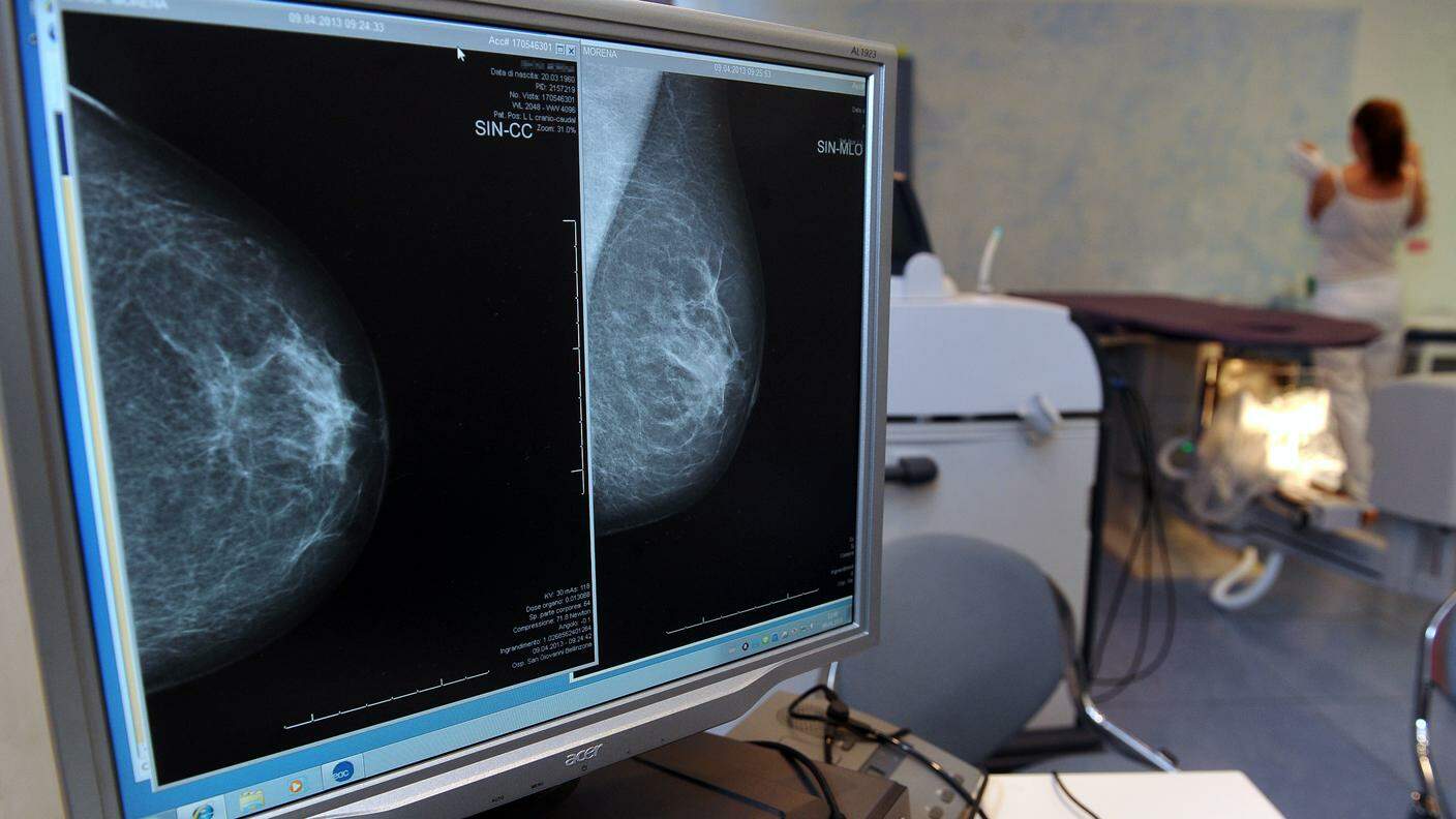Lo schermo con l'immagine di un tumore al seno 