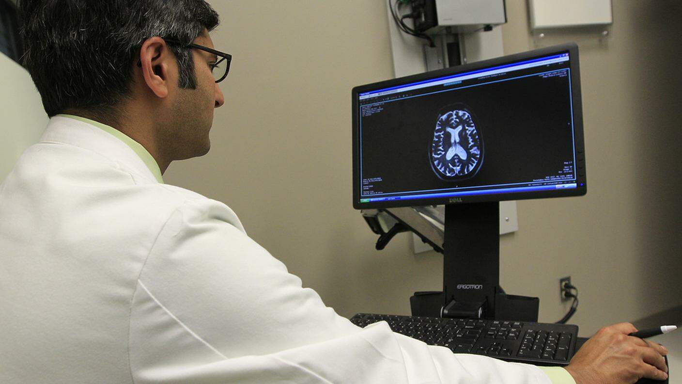 Il cervello di un paziente affetto da Alzheimer