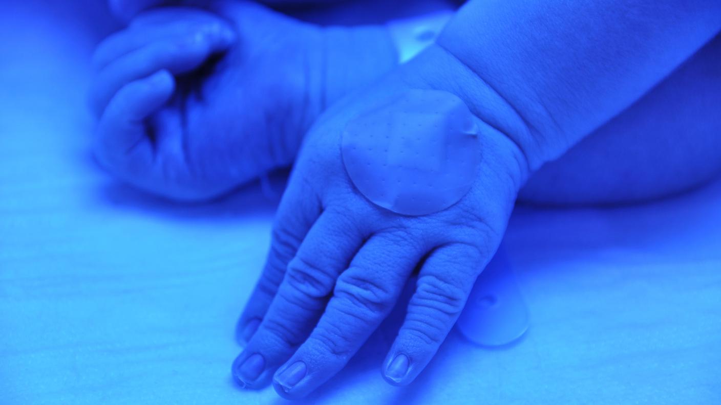 ultraviolet lamps (phototherapy)