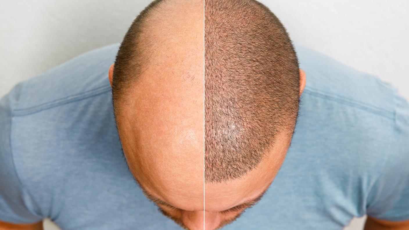 Trapianto di capelli 