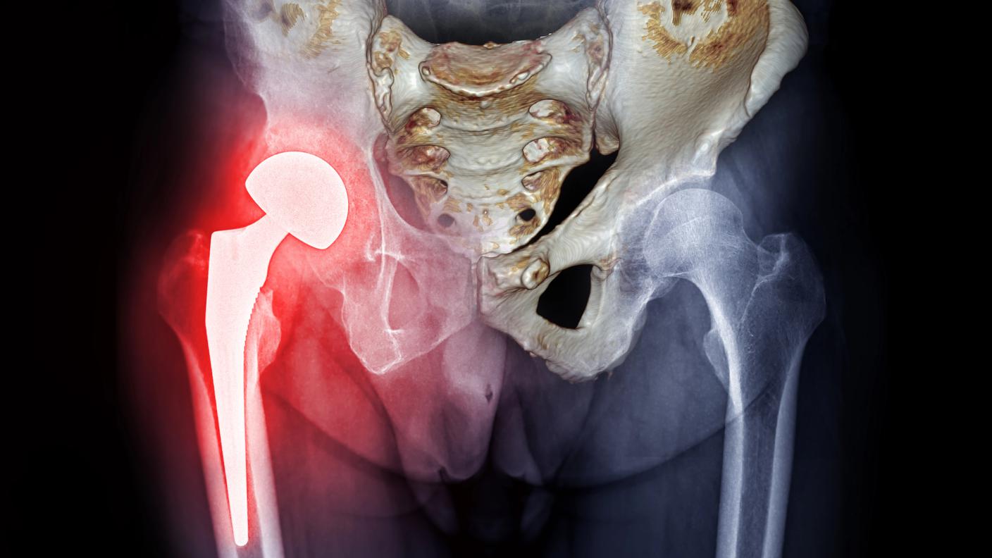 osteoporosi