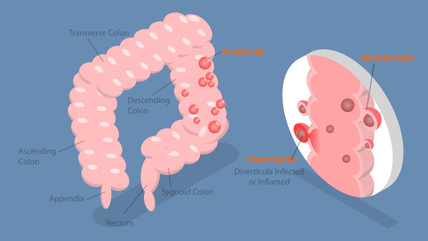 Diverticoli