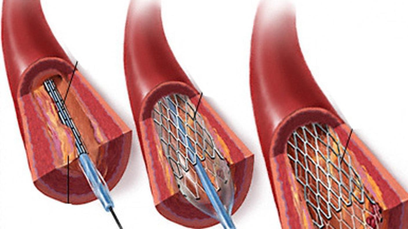 Stent-cuore-dopo-infarto.jpg
