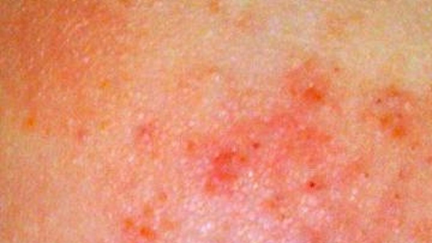 Dermatite da contatto