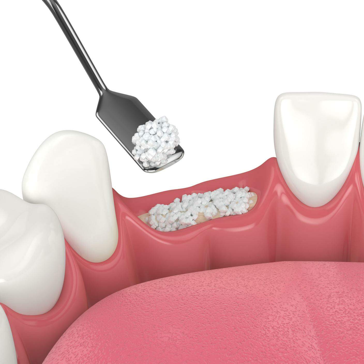 innesto osseo dentale con biomateriale osseo dentale 