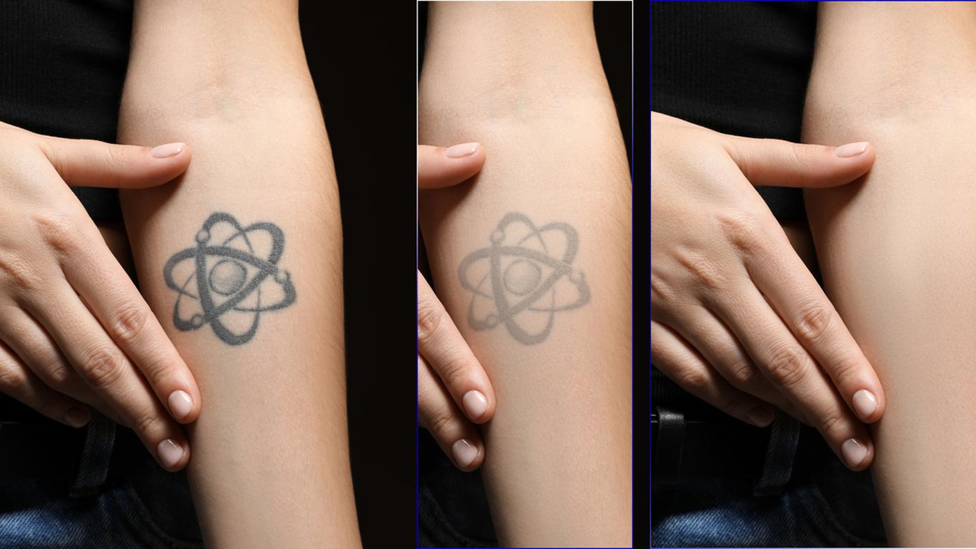 Togliere un tatuaggio